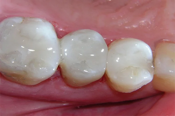 آمالگام دندانی