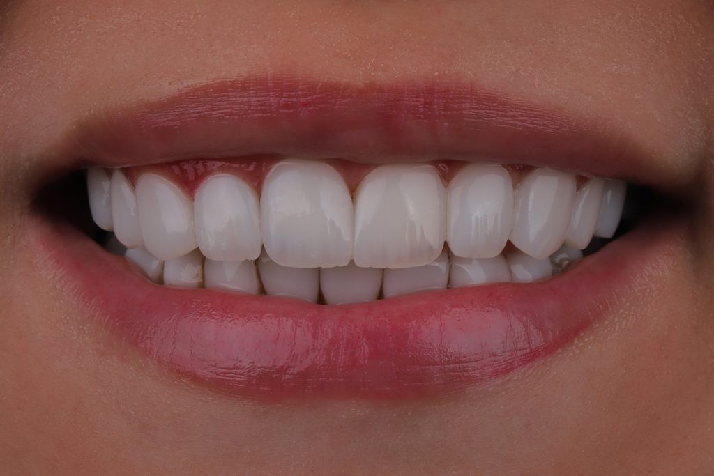 مراقبتهای بعد از کامپوزیت دندان