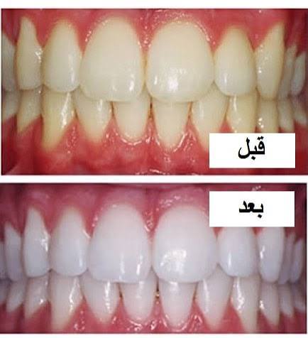 بروساژ دندانپزشکی چیست ؟