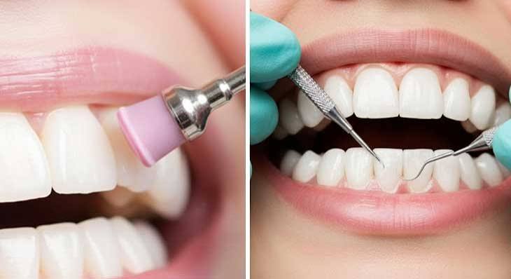 تفاوت جرم گیری و بروساژ چیست؟