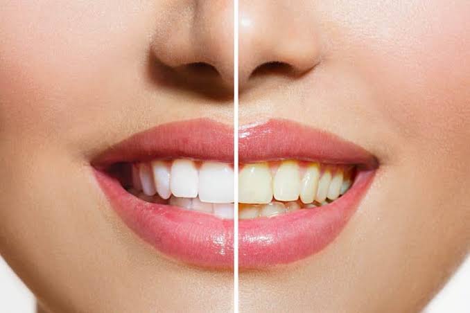 راهنمای انتخاب خمیر پولیش دندانپزشکی